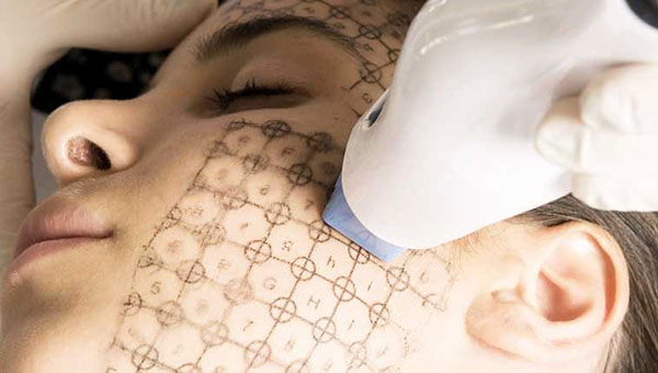 công nghệ thermage flx