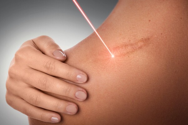 laser trị sẹo lõm 